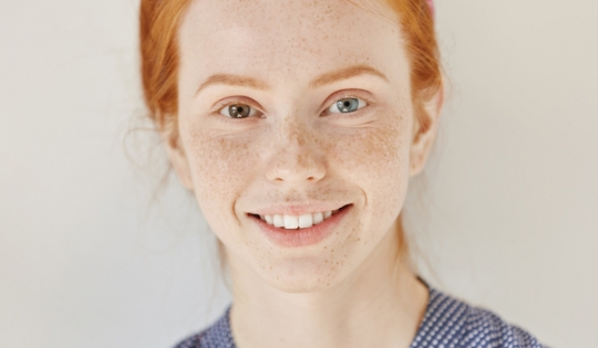 Heterocromia: O porquê de algumas pessoas terem um olho de cada cor